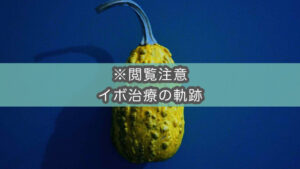 【閲覧注意】足裏イボを治療するとこうなる（患部画像あり）